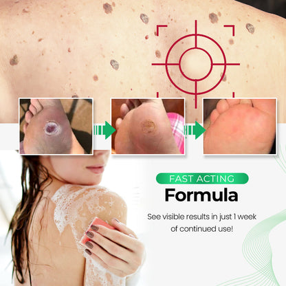 🎁Last Day Promotion 40% OFF - SmoothSkin™ Wart Eliminator Soap