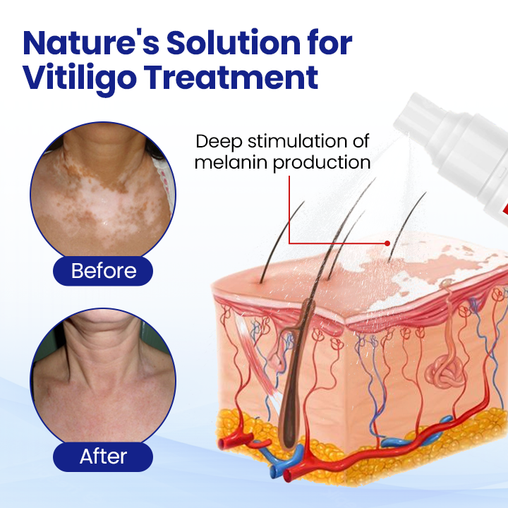 ODEIUN™ Vitiligo Treatment Spray