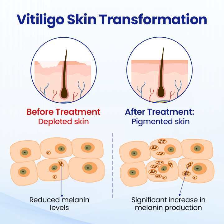 ODEIUN™ Vitiligo Treatment Spray
