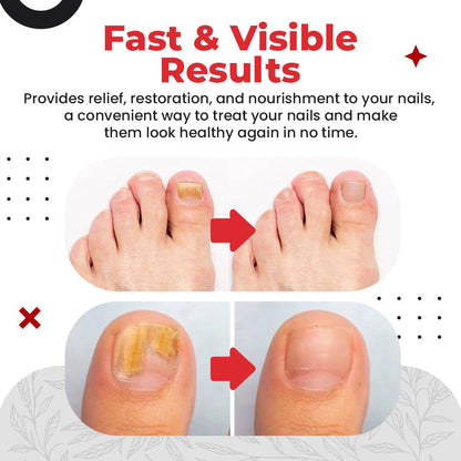 ToenailPro™ Anti Fungus Relief Oil