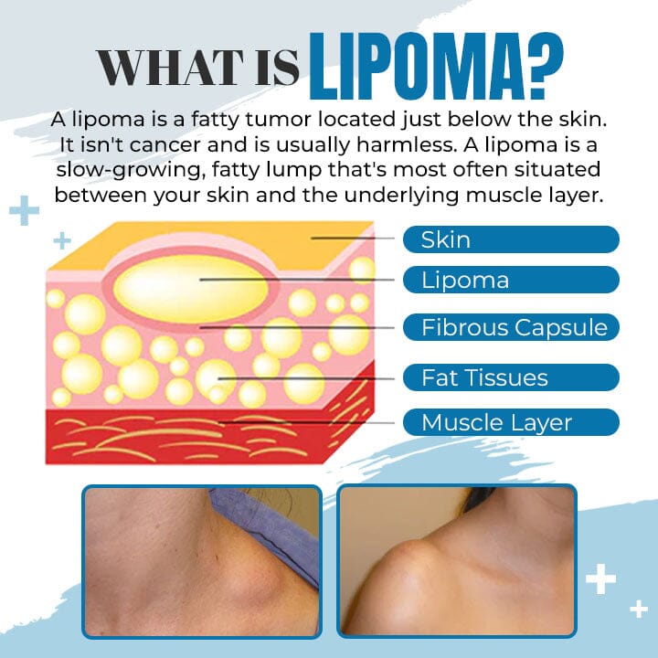 Lipoma Removal Ointment
