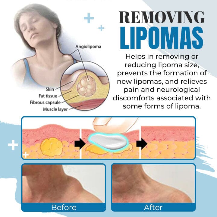 Lipoma Removal Ointment