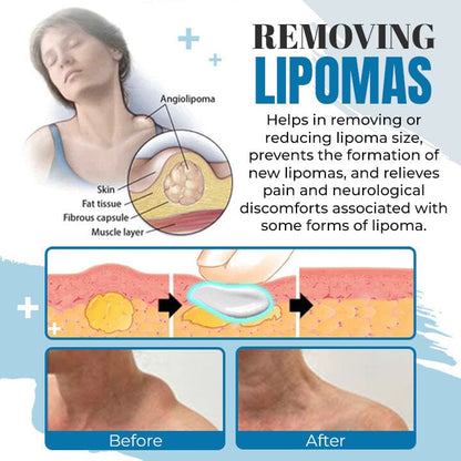 Lipoma Removal Ointment