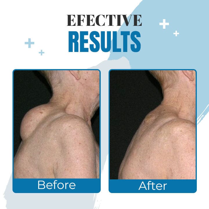 Lipoma Removal Ointment