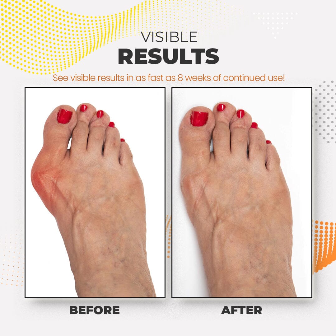 Feetin™ Bunion Relief Fit Patch