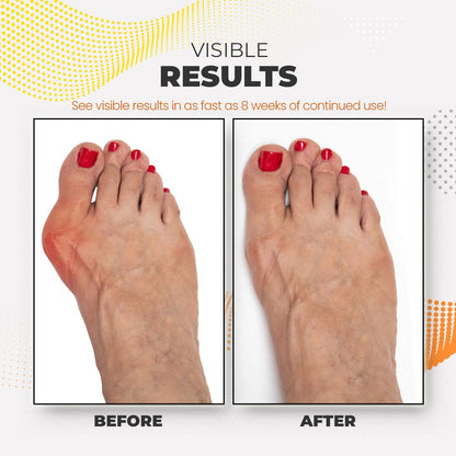 Feetin™ Bunion Relief Fit Patch