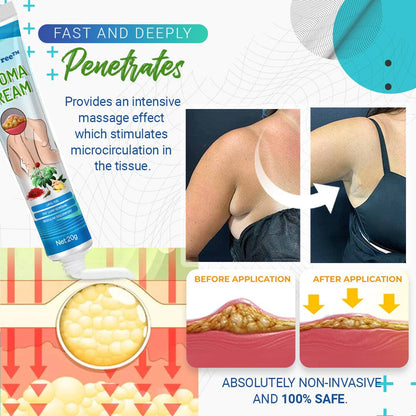 LumpFree™ Lipoma Removal Cream