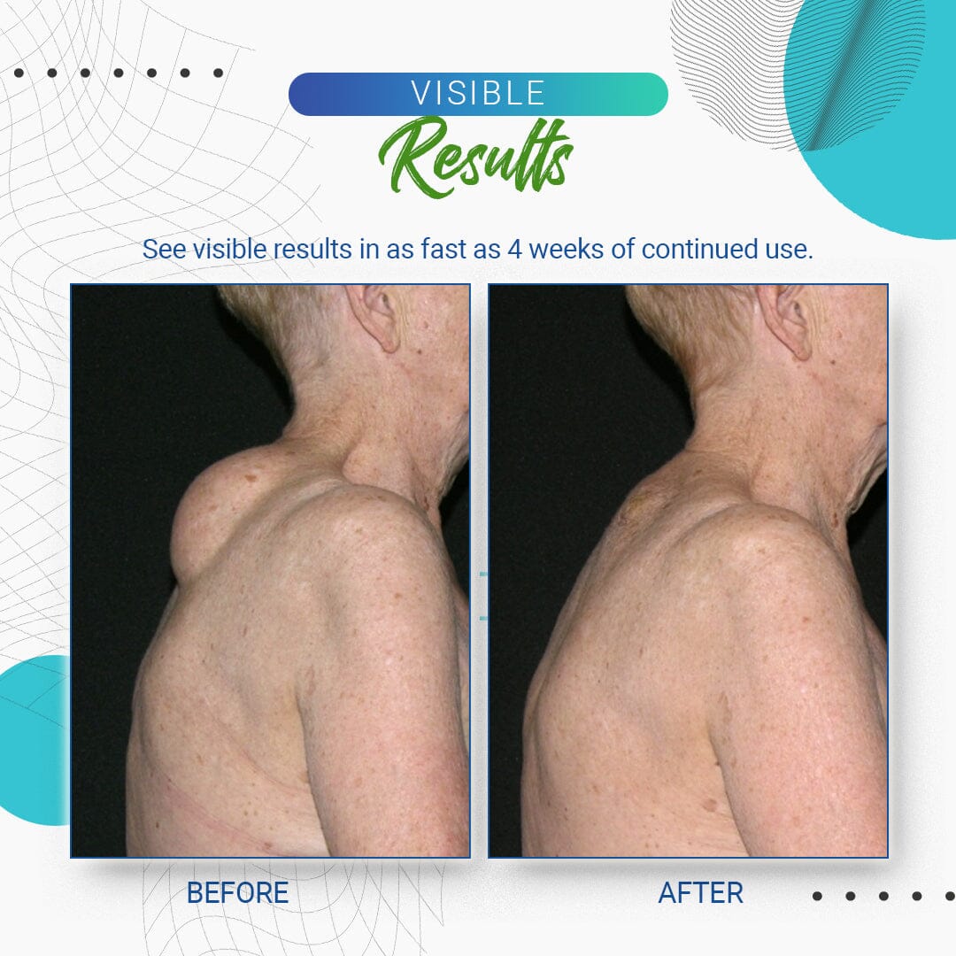 LumpFree™ Lipoma Removal Cream