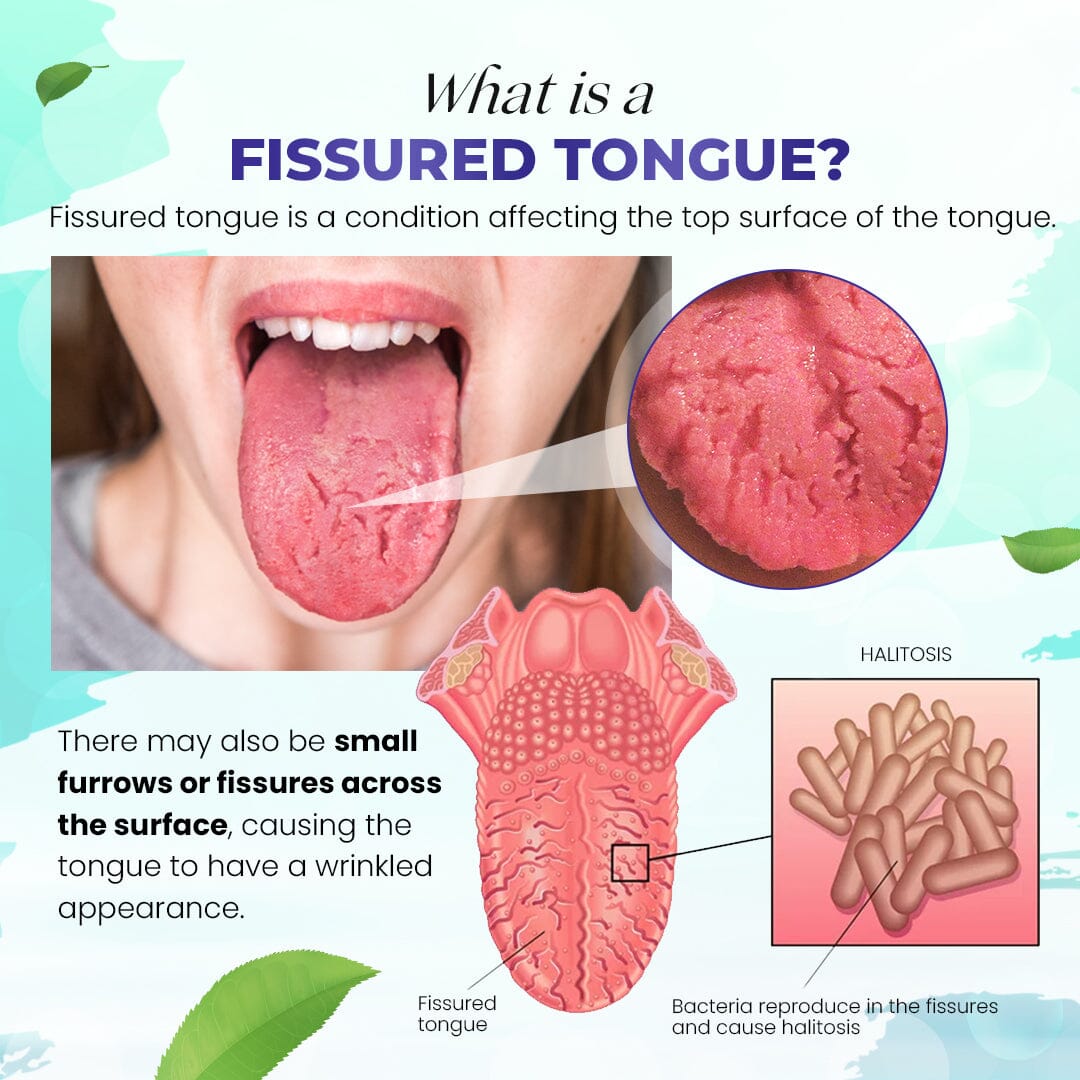 Canada Polumna™ Fissured Tongue Relief Spray