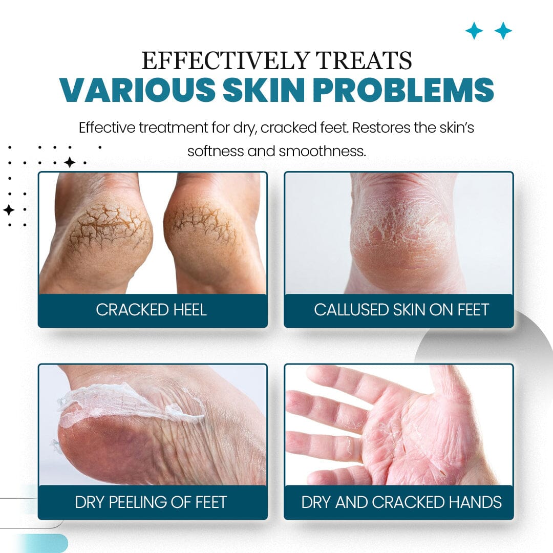 HeelHaven™ Severe Cracked Heel Balm