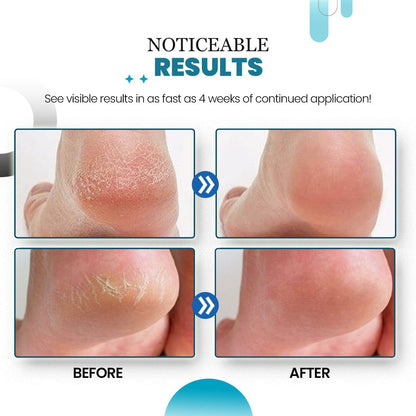 HeelHaven™ Severe Cracked Heel Balm